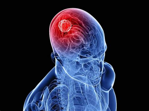 Brain Tumor 10 Brain Tumor Symptoms