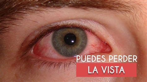 21 Enfermedades De Los Ojos Más Comunes【síntomas Y Tratamiento】