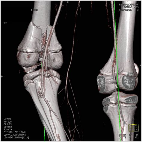Comminuted Distal Femur Fracture Without Vascular Injury On Cta