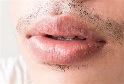 Fordyce Spots On The Lips Causes Symptoms And Treatment