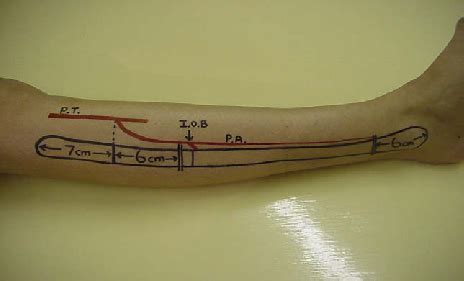 Planning Of Fibula Osteotomy Site Photograph Shows Skin Markings Of