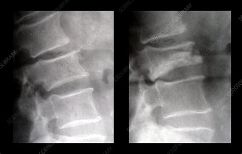 Lumbar Compression Fracture Stock Image M3301636 Science Photo
