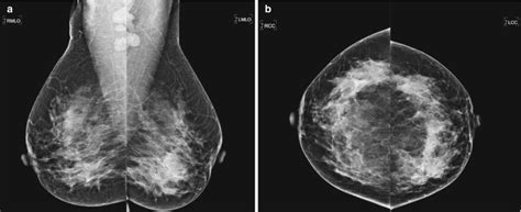 Diagnosis And Staging Of Breast Cancer When And How To Use Mammography