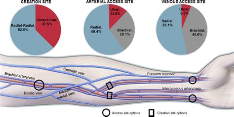 Endovascular Creation Of Arteriovenous Fistulae For Hemodialysis Access