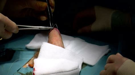 Circumcision Surgery Videos And Hd Footage Getty Images