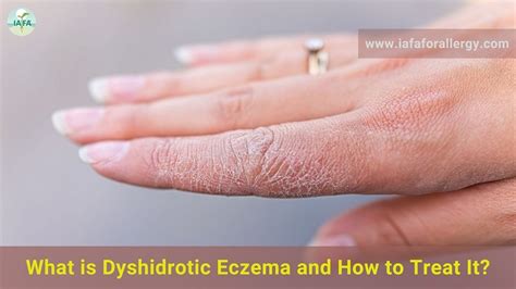 What Is Dyshidrotic Eczema And How To Treat It
