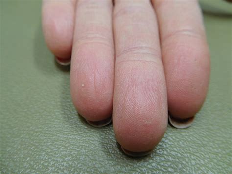 Cureus Capecitabine Associated Loss Of Fingerprints Report Of