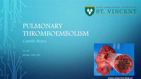 Pulmonary Thromboembolism Ppt