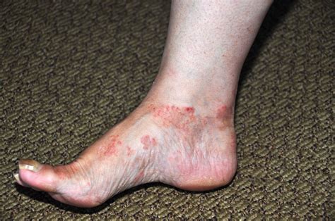 Skin Rash On Ankle