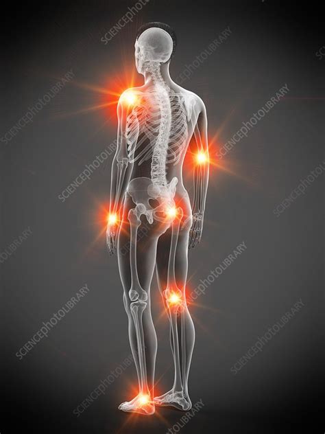 Joint Pain Conceptual Illustration Stock Image F0257508 Science