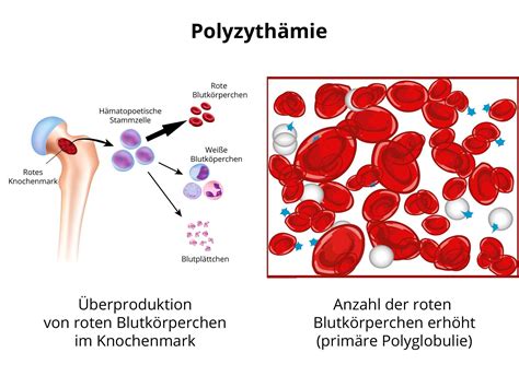 Polyzythämie Polycythaemia Vera