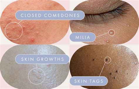 Bumps On The Skin On Your Face What They Are And What You Can Do
