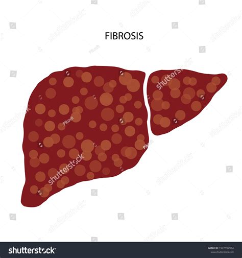 Fibrosis Logo Scar Tissue Liver Damaged Vetor Stock Livre De Direitos