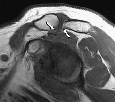 Magnetic Resonance Imaging Of Rotator Cuff Disease And External