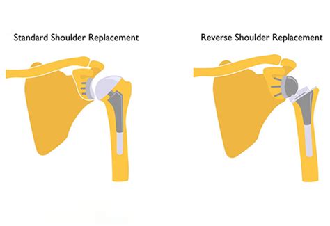 Reverse Total Shoulder Replacement Johns Hopkins Medicine