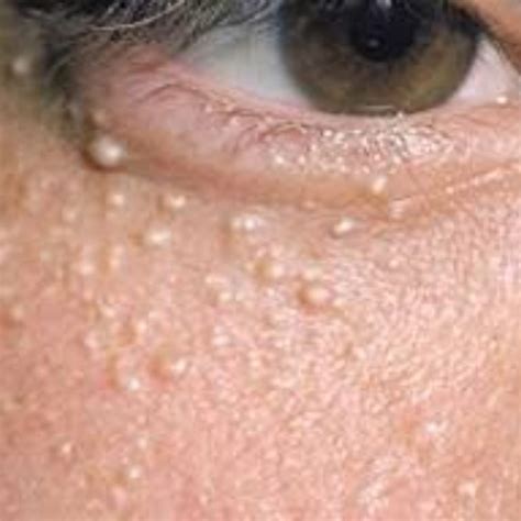 Milia Or Milk Spots Skin Hub