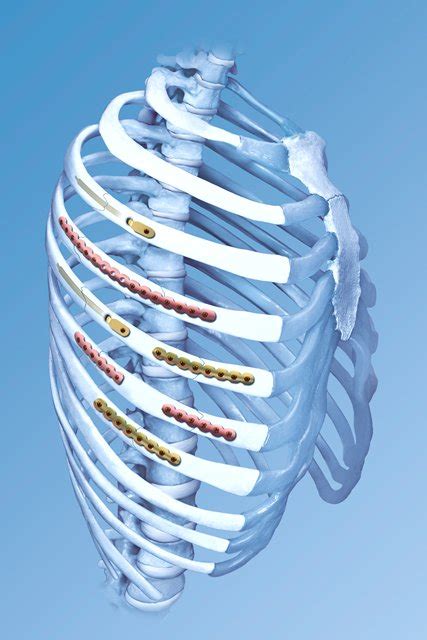 Mis Rib Fracture Fixation With Us Launch Of Depuy Synthes Cmf Matrixrib