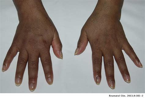 Generalized Skin Hyperpigmentation And Longitudinal Melanonychia