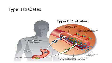 How To Control And Reverse Type 2 Diabetes Youtube