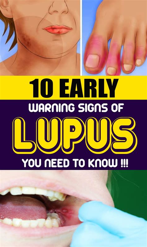 Early Warning Signs Of Lupus You Need To Know Healthy Lifestyle