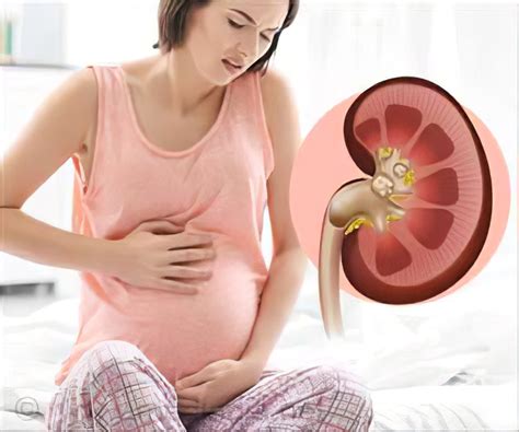 About Kidney Stone Complications You Wish You Knew Before Butn