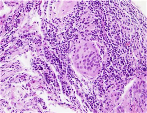 Histological Images Of Transbronchial Lung Biopsy Specimen Revealed