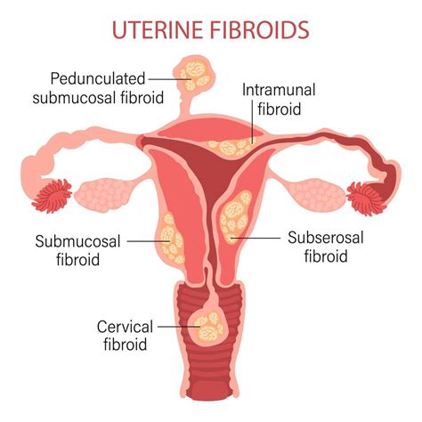 Types Of Uterine Fibroids In Women Fibroids Diseases Of The Female Reproductive System