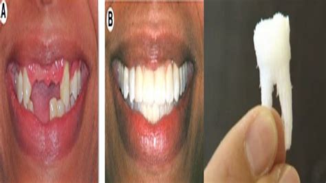Stem Cell Dental Implants Grow New Teeth In Your Mouth Teethwalls