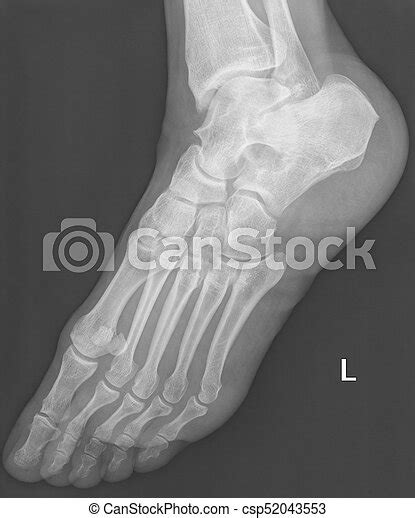 Female Feet Xray Radiograph X Ray Radiograph Of Human Female Feet Bones L Means Left Side