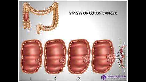 Colon Cancer Powerpoint Presentation Template Youtube