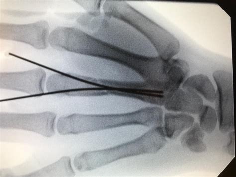 Hand Metacarpal Fractures Decatur Orthopedica Center Il