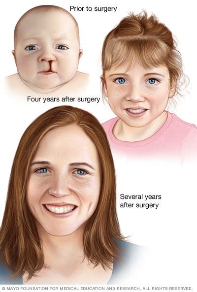 Cleft Lip And Cleft Palate Diagnosis And Treatment 2023