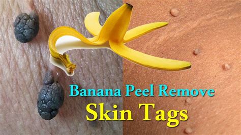 banana peel remove skin tags skin tags removal naturally home remedies to get rid of skin