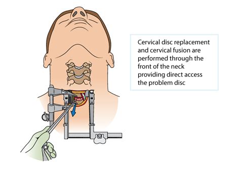 Cervical Disc Replacement Or Fusion Dr Yu Chao Lee