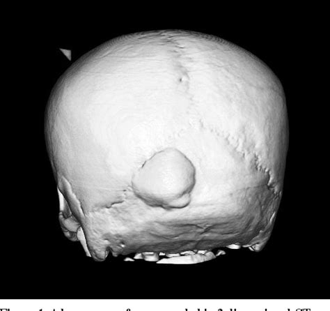 Figure 1 From Occipital Bone Osteoma Semantic Scholar