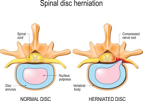 Disc Herniation Causes Symptoms And Treatment Bauerfeind Australia