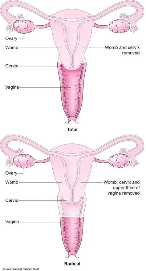 having a hysterectomy jo s cervical cancer trust