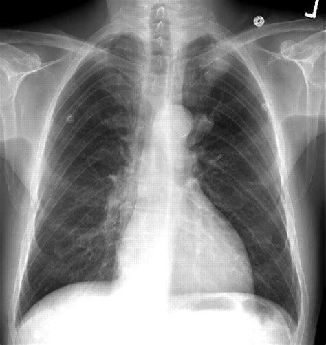 Percutaneous Lung Biopsy In A Patient With A Cavitating Lung Mass