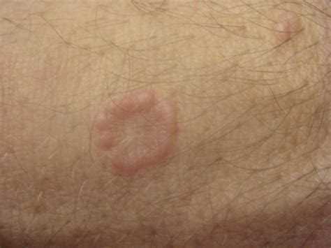 Granuloma Annulare Pictures Causes Diagnosis Complications And