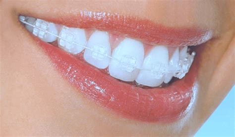 Best Braces For Adults To Straighten Teeth Most Efficiently