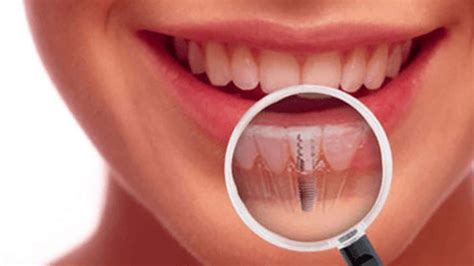 Common Dental Implant Problems Smile Team Turkey