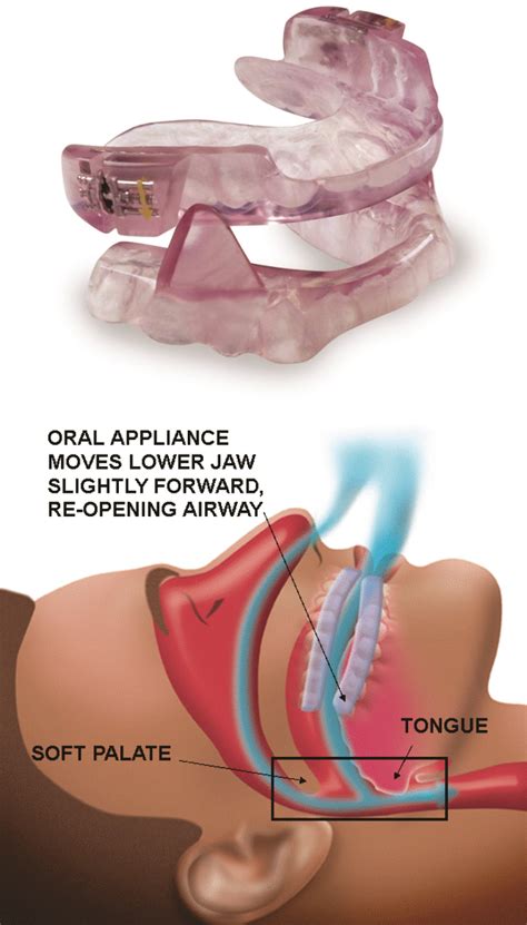 Oral Appliance For Sleep Apnea Advanced Dental Concepts Blog