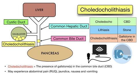 Choledocholithiasis Ercp