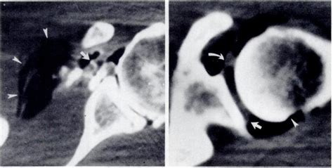 Double Contrast Ct Arthrogram Of Upper Shoulder Joint Shows A