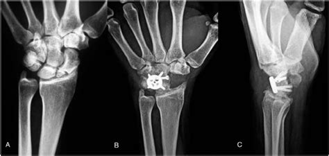 Wrist With A Snac Iii Lesion A Final Radiograph Of Four Corner Download Scientific Diagram