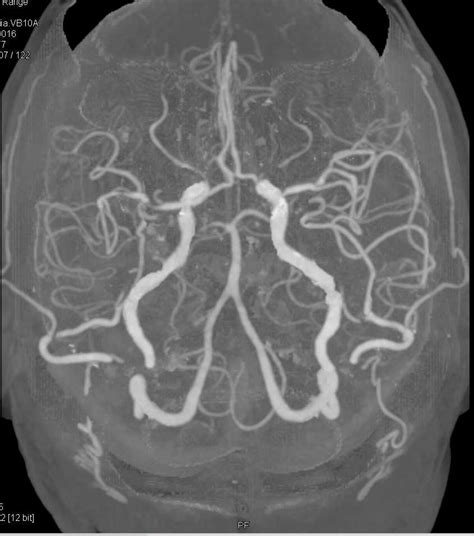 Normal Circle Of Willis And Carotid Artery Stenosis Neuro Case My XXX