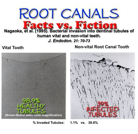 Here is a list of foods to eat and to avoid after a root canal. E. faecalis Survives in Root Canaled Tooth System Archives ...