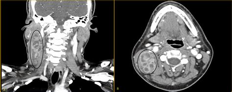 Cureus An Adult Female Presenting With Scrofula Tubercular