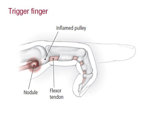 Conditions Trigger Finger The Body Rehab