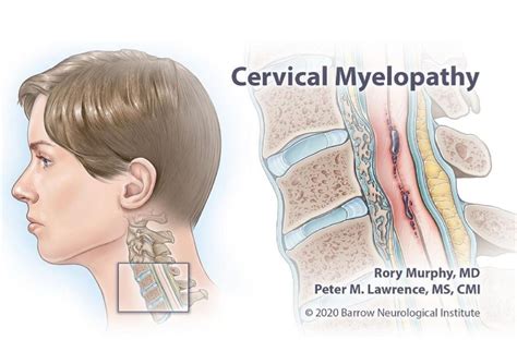 Cervical Spondylotic Myelopathy Pathophysiology Diagnosis And My XXX Hot Girl